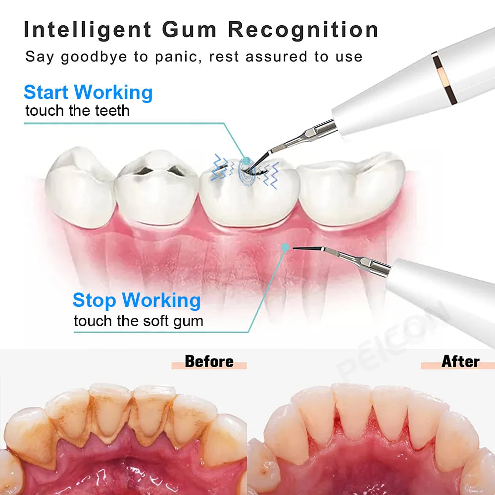 Ultrasonic Dental Scaler Calculus Remover